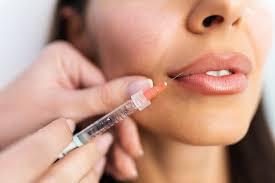 lip filler.jpeg