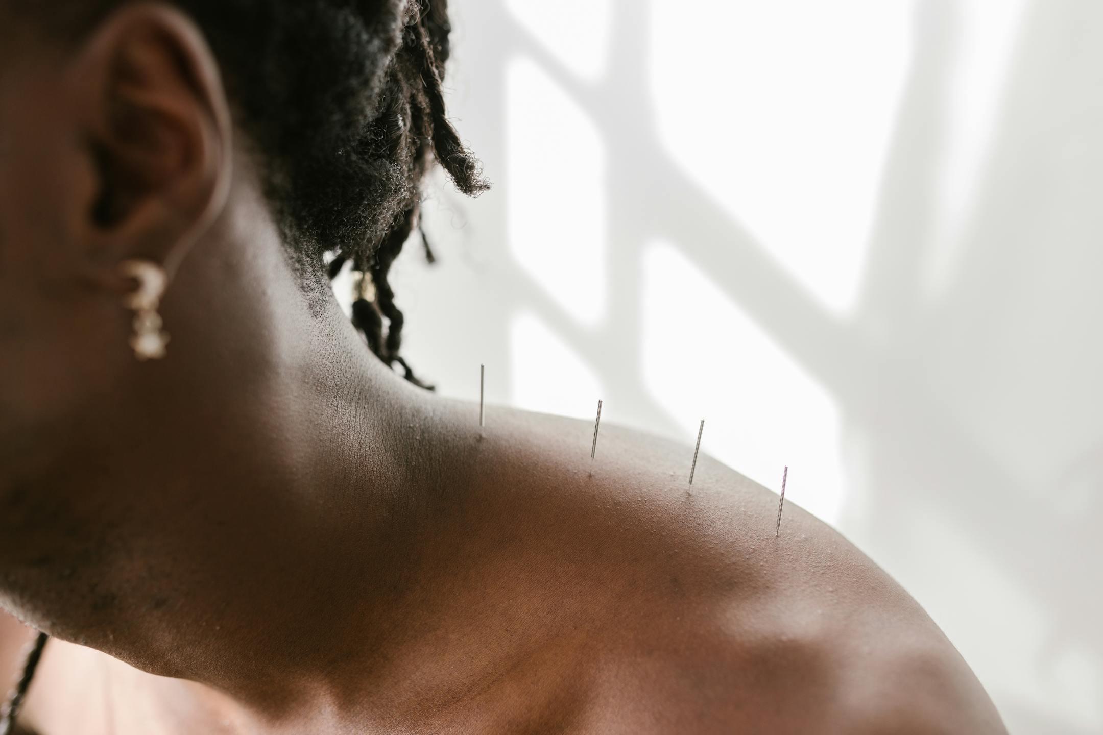 Detailed view of acupuncture needles applied to a shoulder for therapeutic treatment.