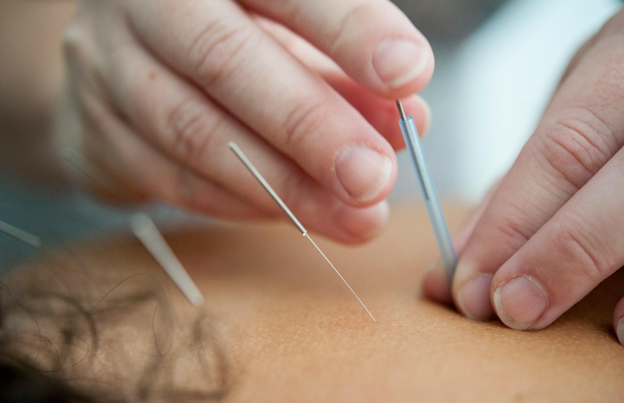 Appointment for acupuncture in Paramus, NJ