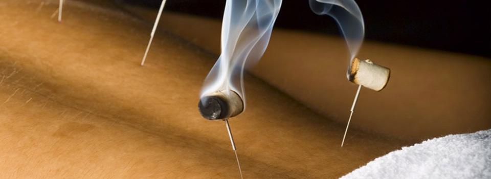 Needles stuck in someone's lower back with smoking things attached. In Bergen, acupuncture is an unmatched natural pain management tool.