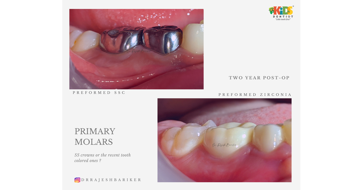 Preformed stainless steel crowns or Preformed zirconia crowns