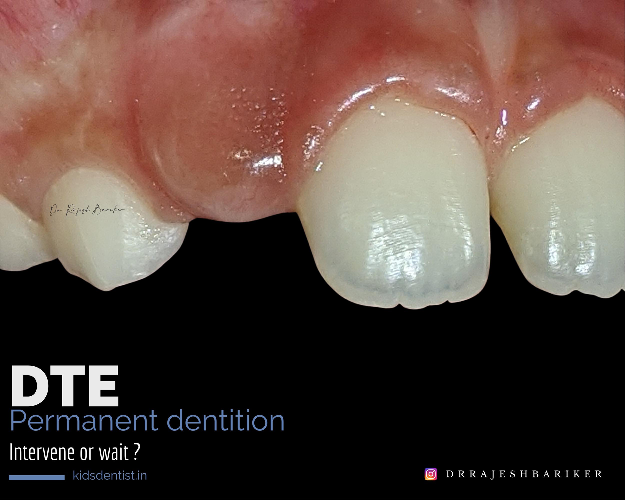 thumb sucking habit.jpg