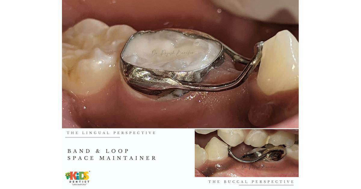 Band and Loop Space maintainers