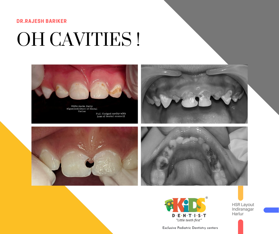 Cavities