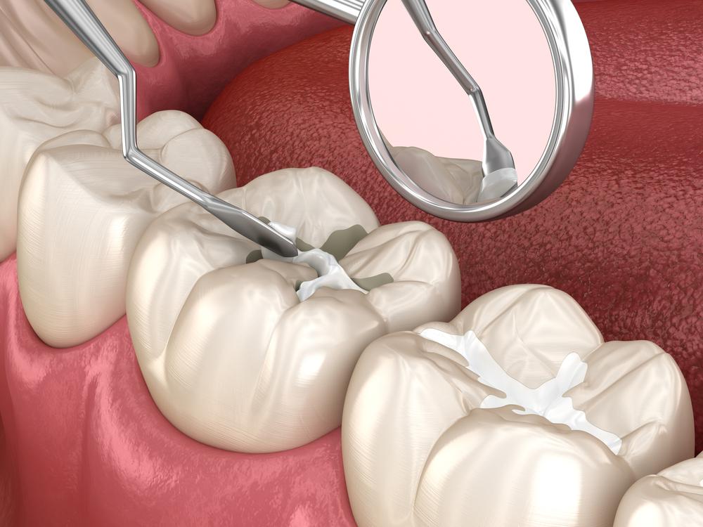 tooth sealants in arlington.jpg
