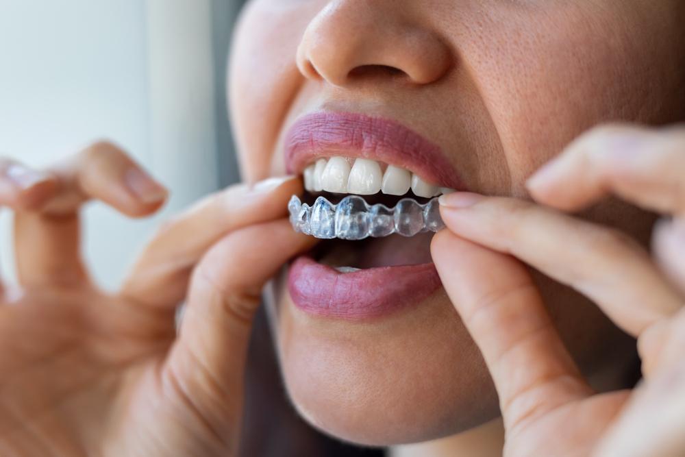 invisalign braces in arlington va.jpg