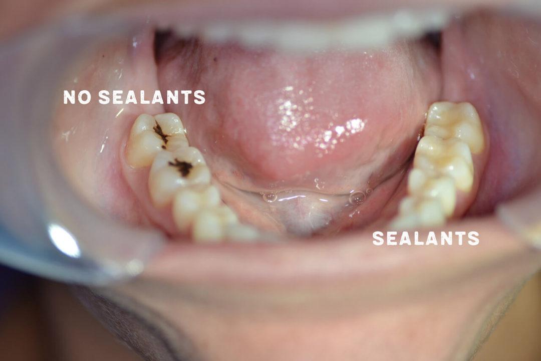 tooth sealants arlington.jpg