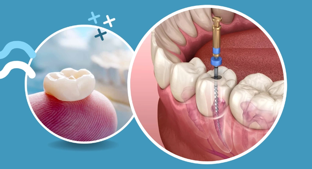 dental crowns arlington.jpg