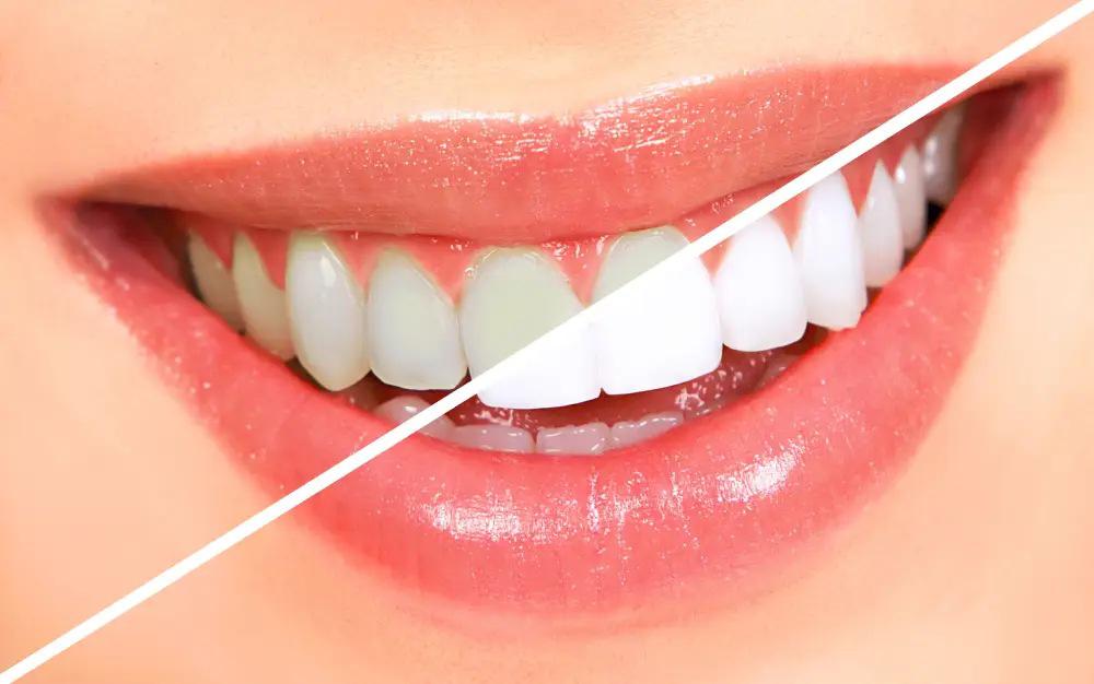 teeth-whitening-1.jpg