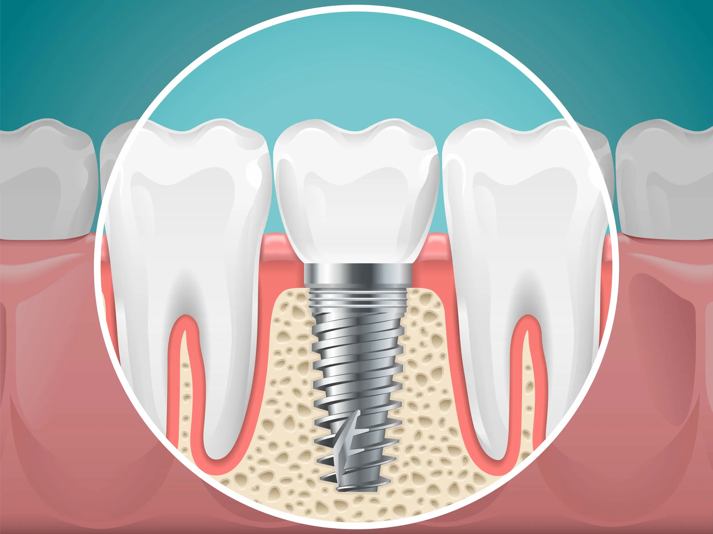 dental-implant-fortitude-valley-qld.webp