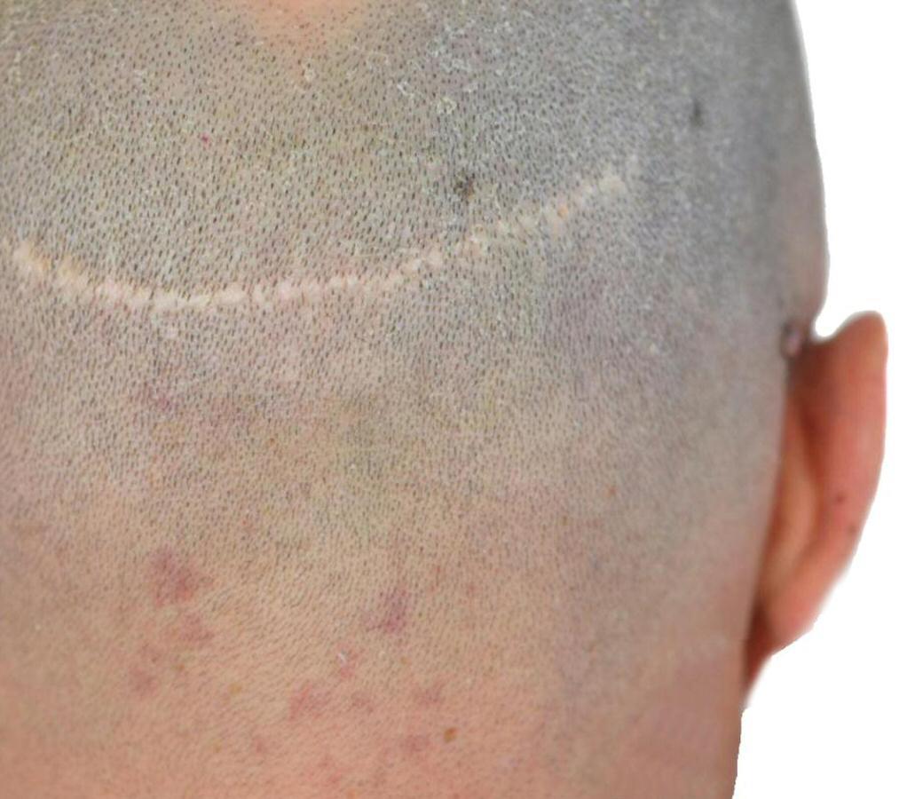 Cicatrice post trapianto coperta con tricopigmentazione – risultato naturale sulla zona occipitale – FM Tricopigmentazione Macerata
