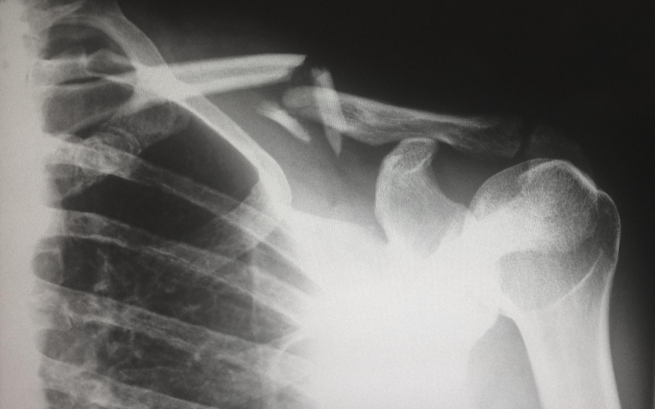 X-ray of a shoulder injury.