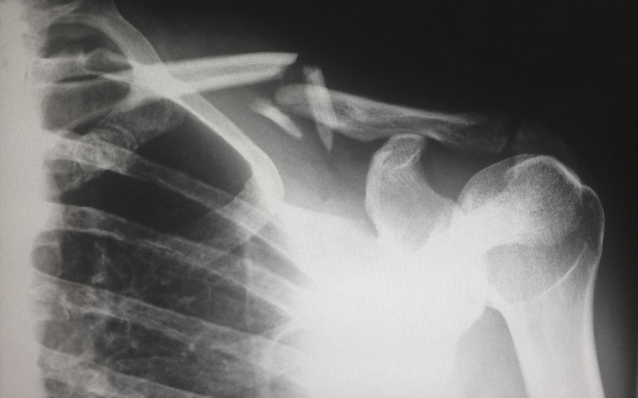 What damages can my personal injury attorney get me in Wilmington, NC?