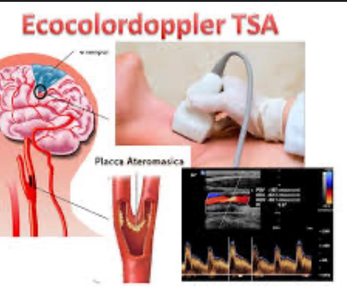 Ecodoppler Tronchi Sovra Aortici (TSA)