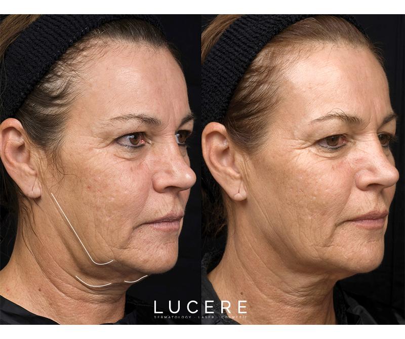 Thermage Skin Tightening