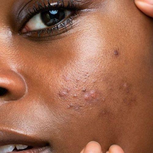 acne.jpeg