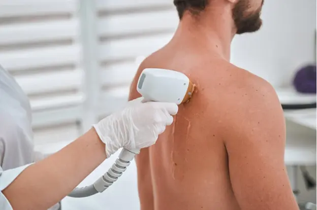 mens-back-hair-removal.webp
