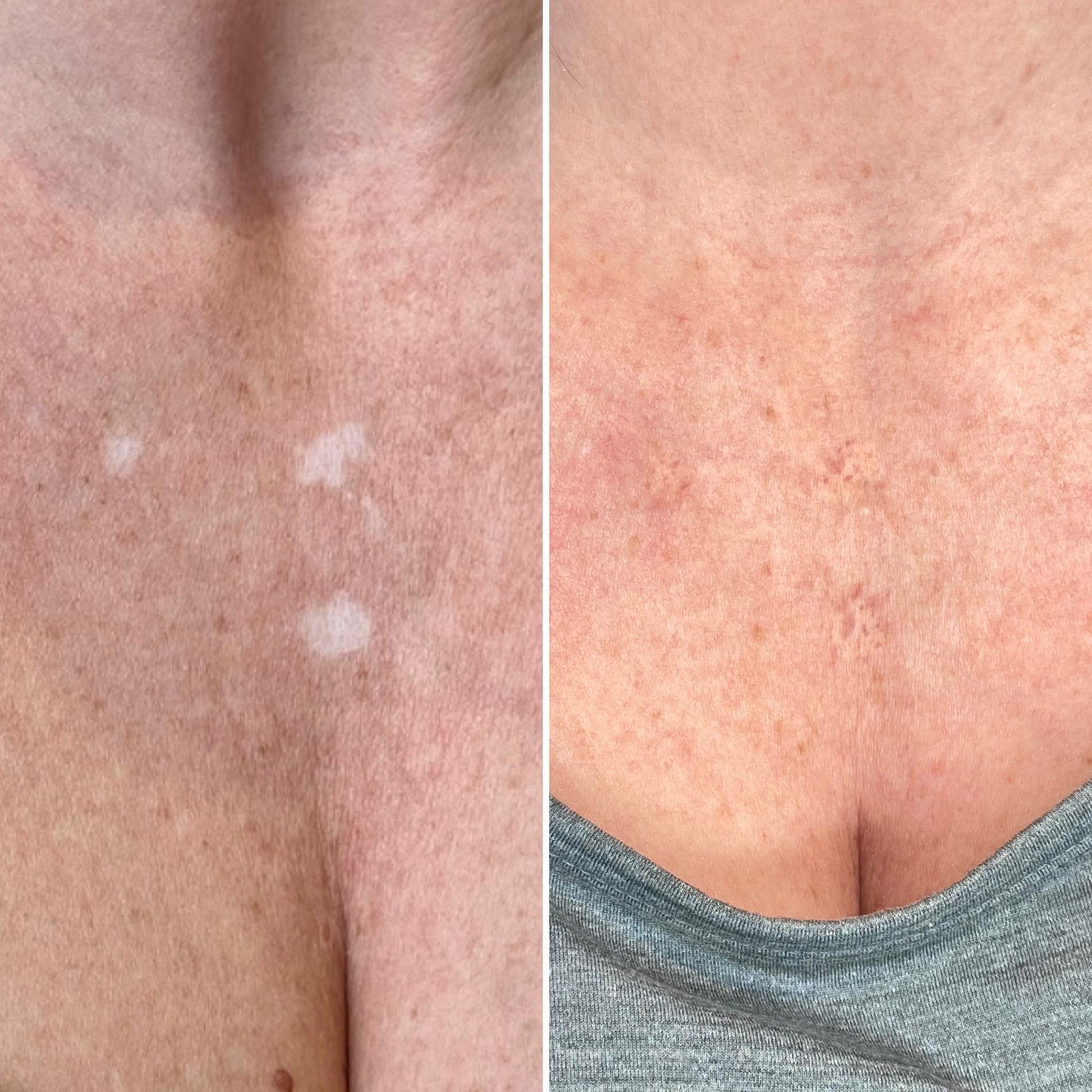 inkless skin revision client results