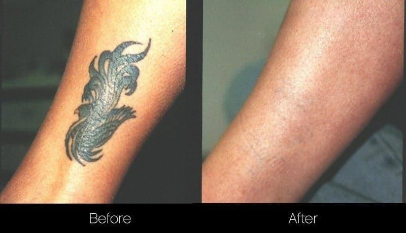 image2_non-surgical_laser-skin-treatmens_laser-tattoo-removal.jpg