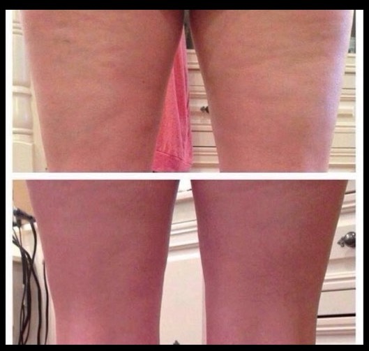 legs skinade before and after