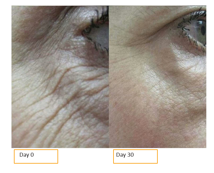 crows feet skinade before and after
