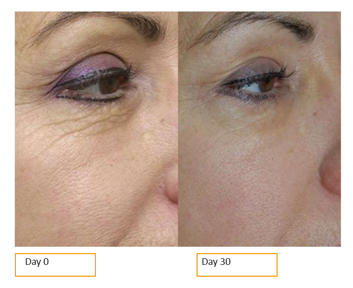 eyes skinade before and after