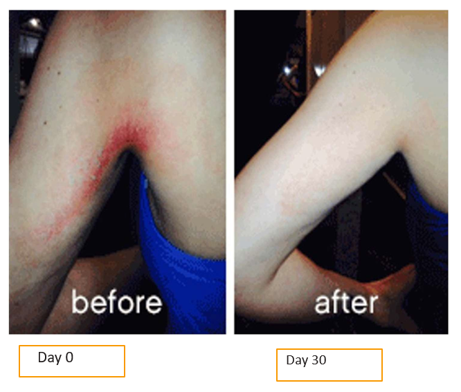armpit skinade before and after