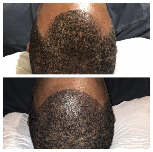 hair restoration treatment dfw area
