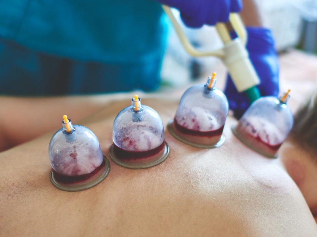 what-are-the-benefits-of-cupping-therapy-on-your-chest-1024x768.jpg
