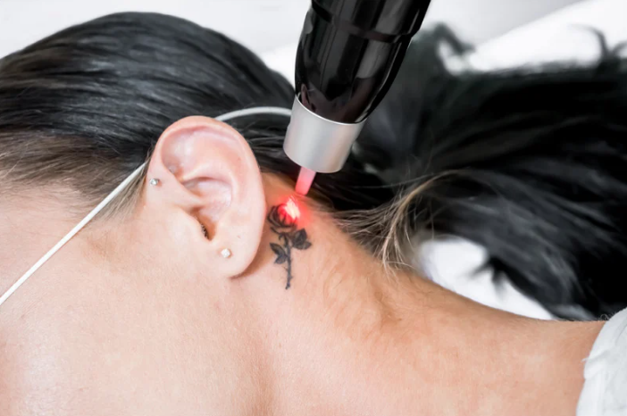 laser tattoo removal.png