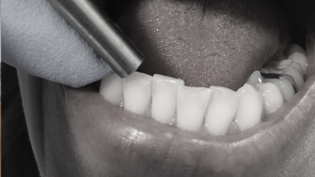 dentist performing a tooth examination