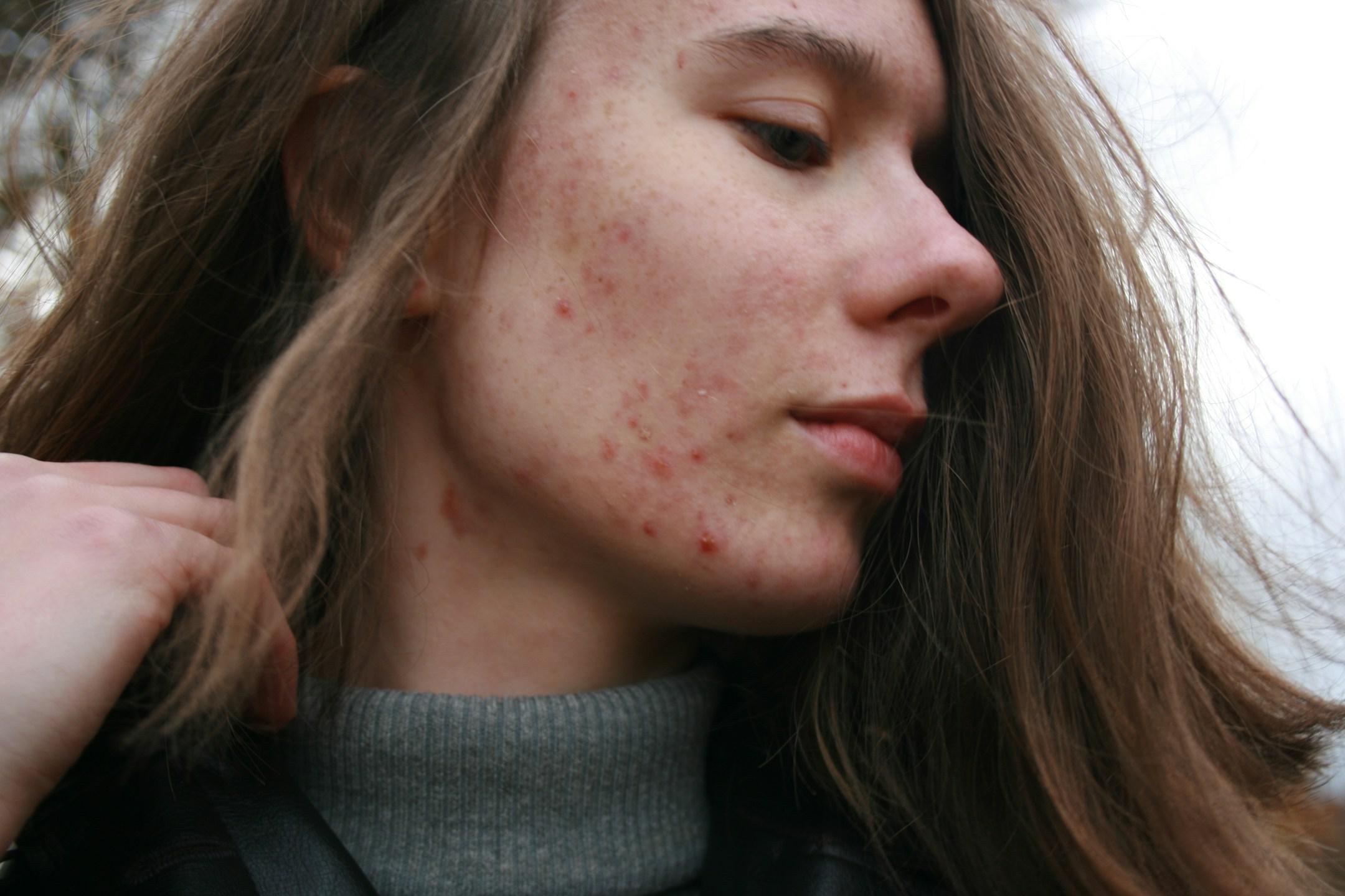 Short story short... Picture I took a day before starting next dermatological treatment to remind myself, how strong I could be regardless of my looks. People vs stereotypes!