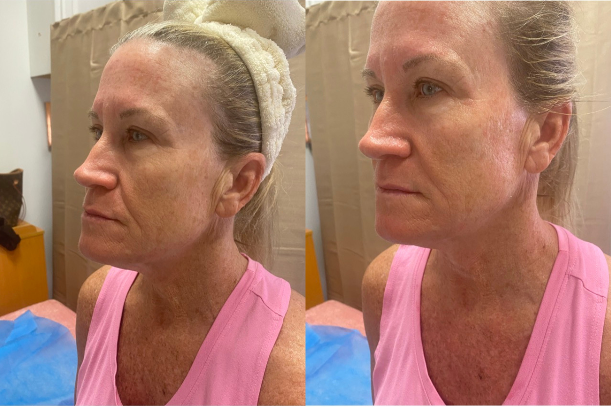 microneedling (4).png
