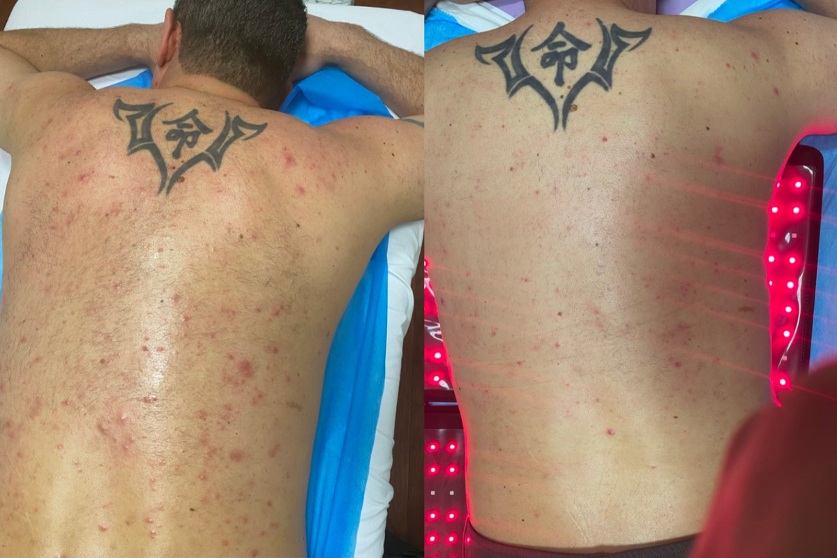 microneedling (11).png
