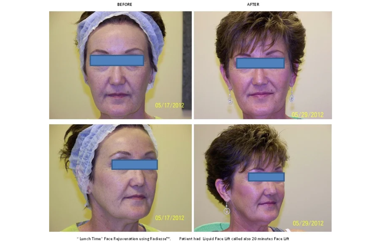 microneedling (7).png