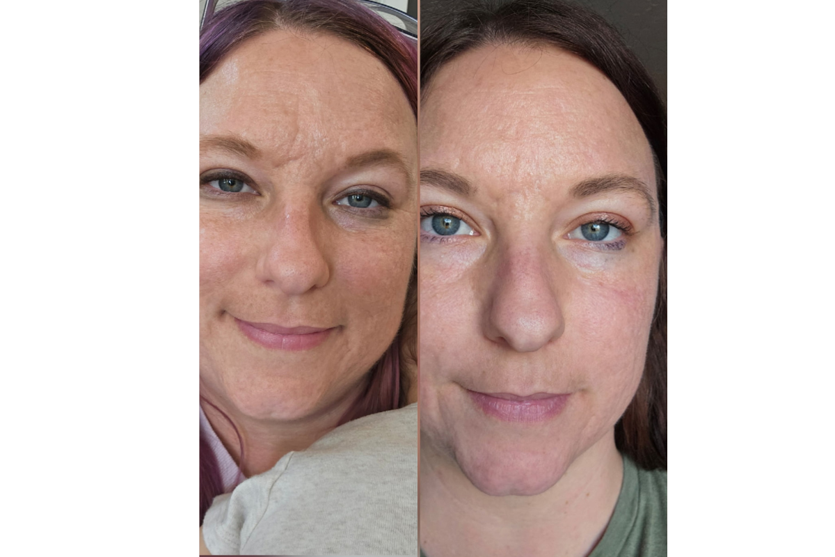 microneedling (10).png