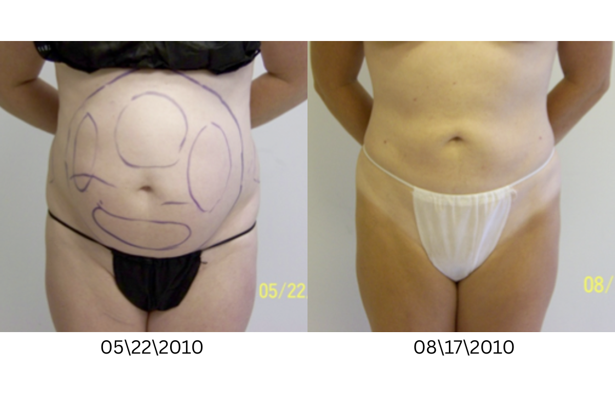 microneedling (6).png