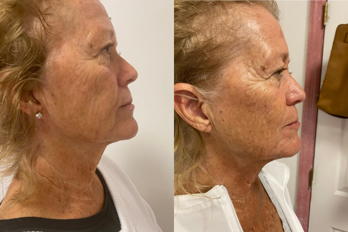 microneedling (5).png