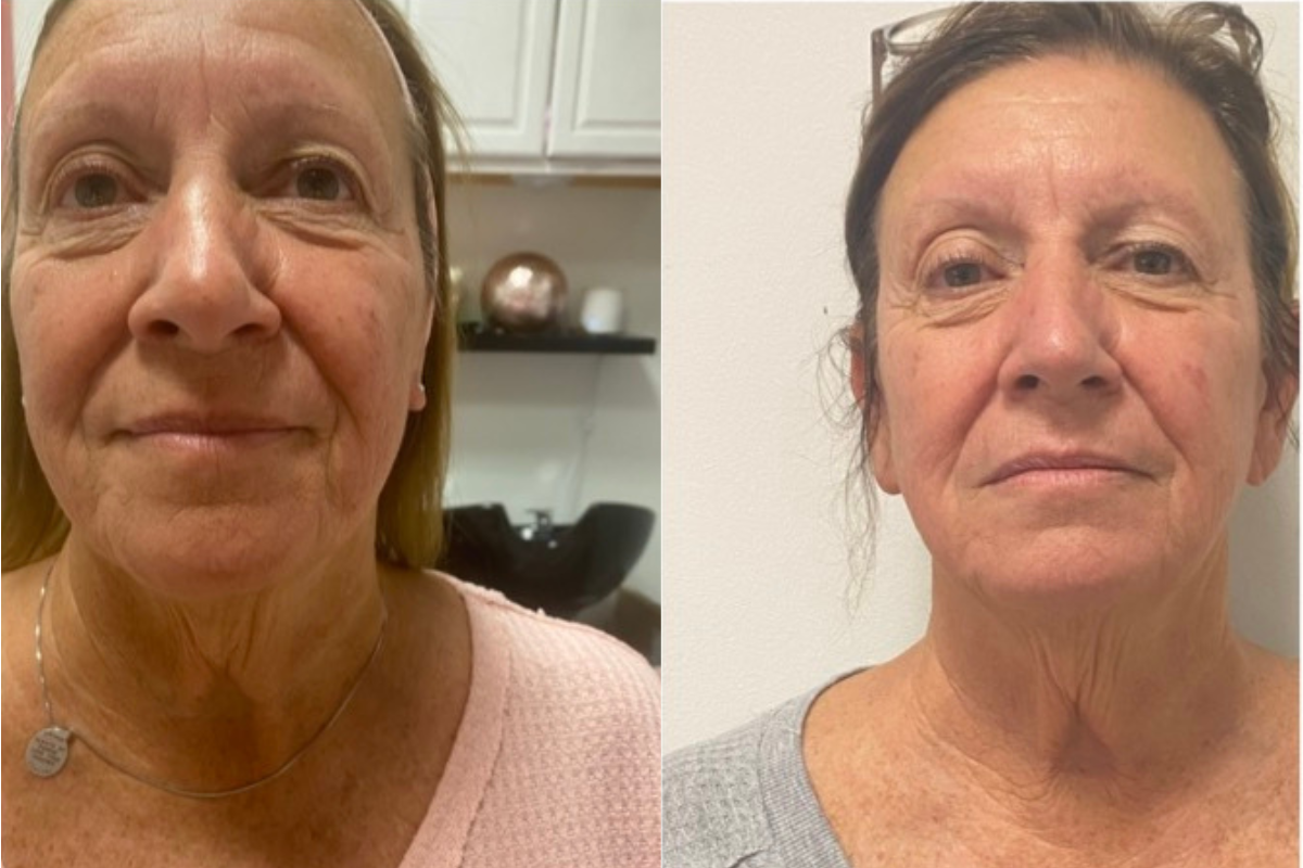 microneedling (8).png