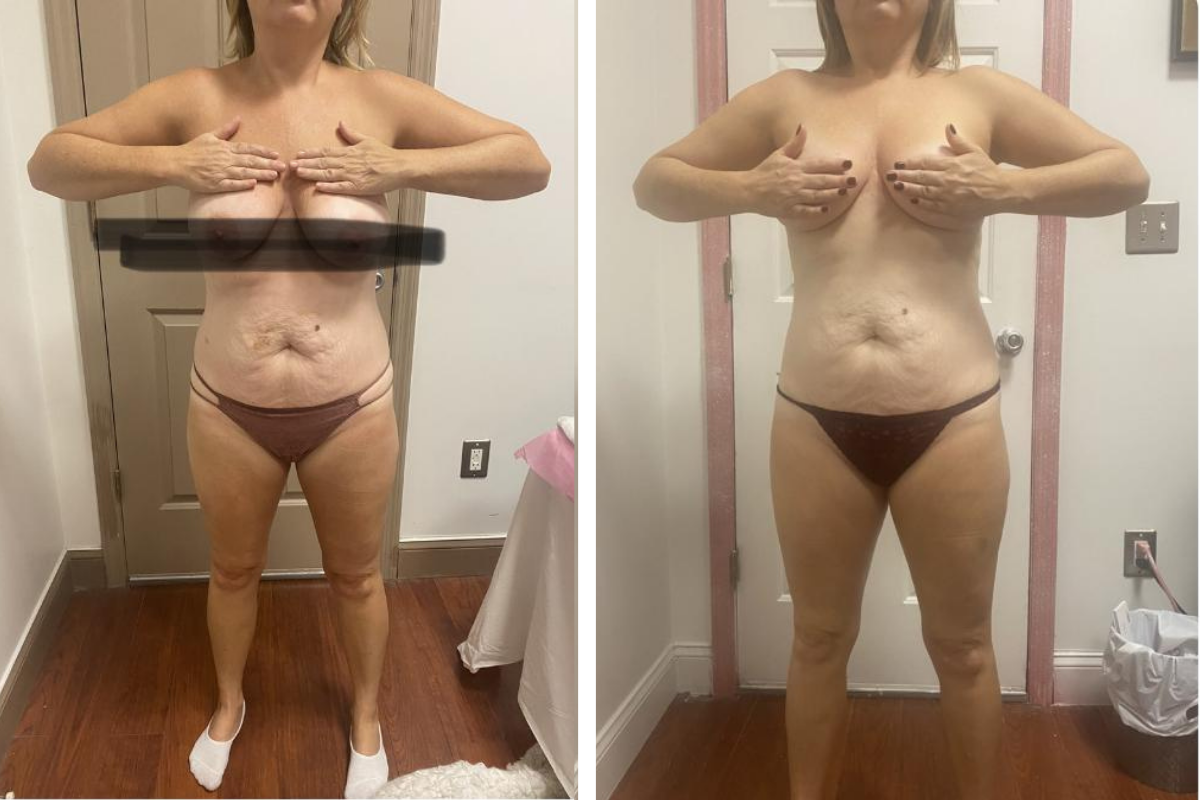 microneedling (3).png