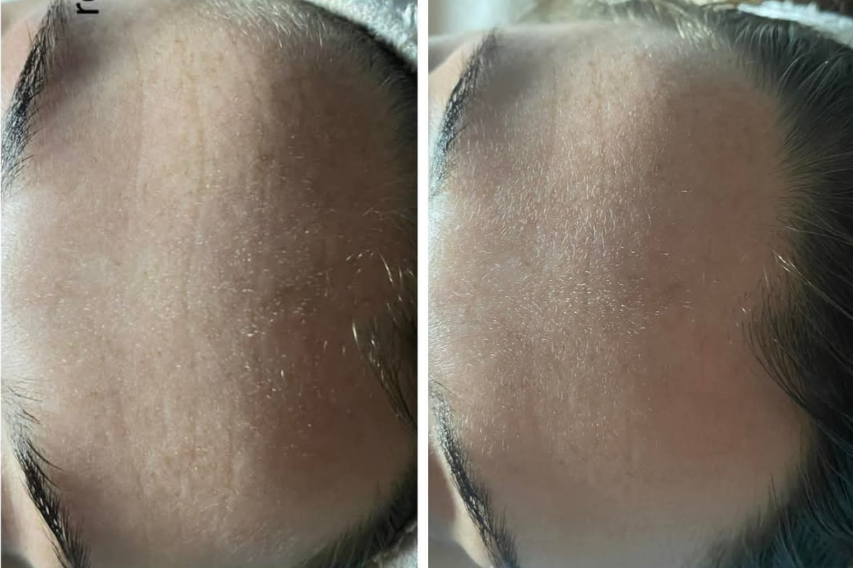 microneedling  (1).png