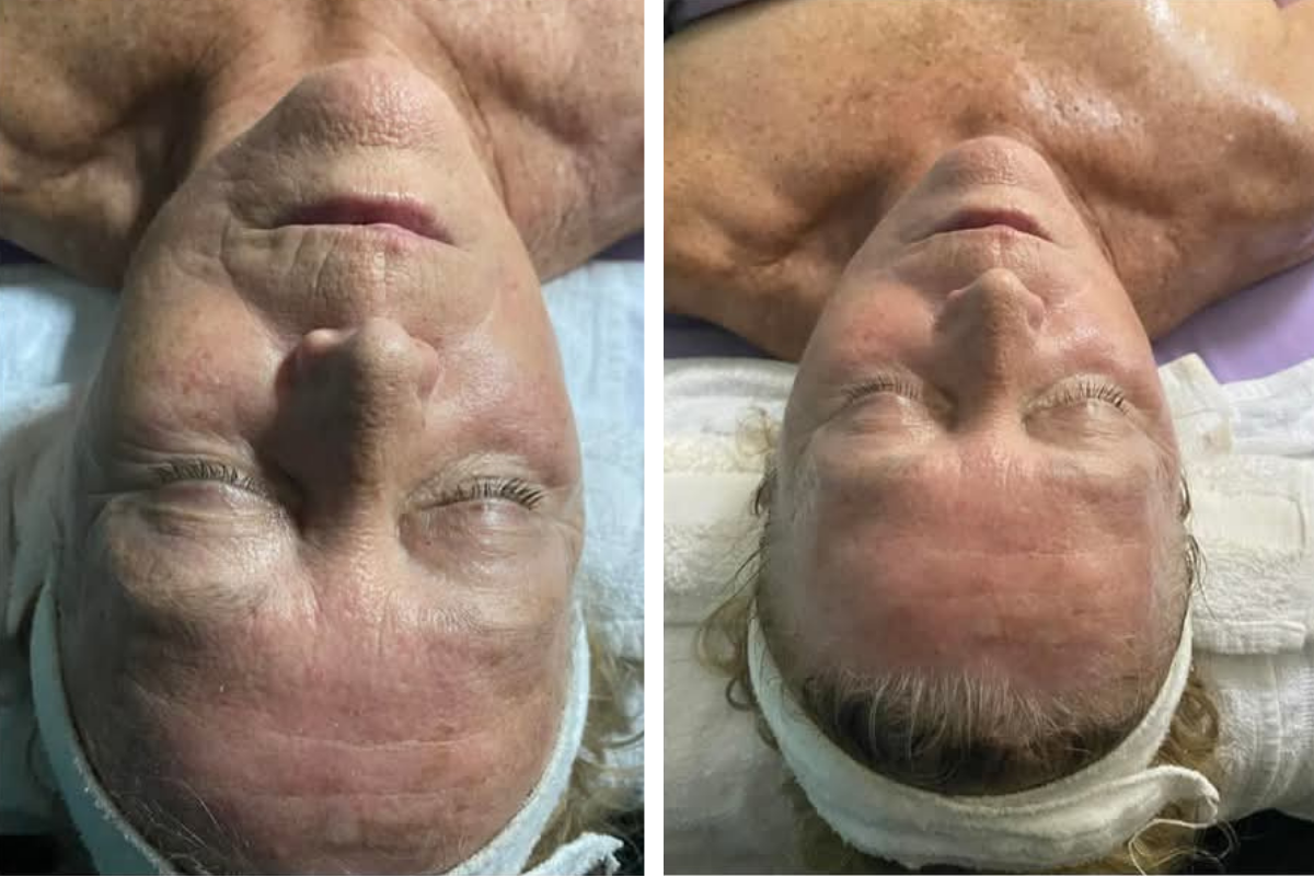 rf treatment  (1).png