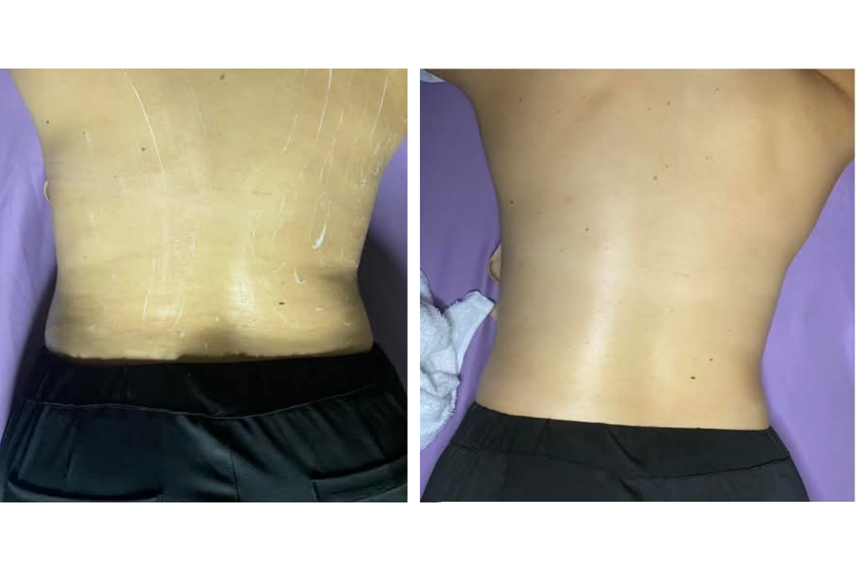 lymphatic drainage  (1).png