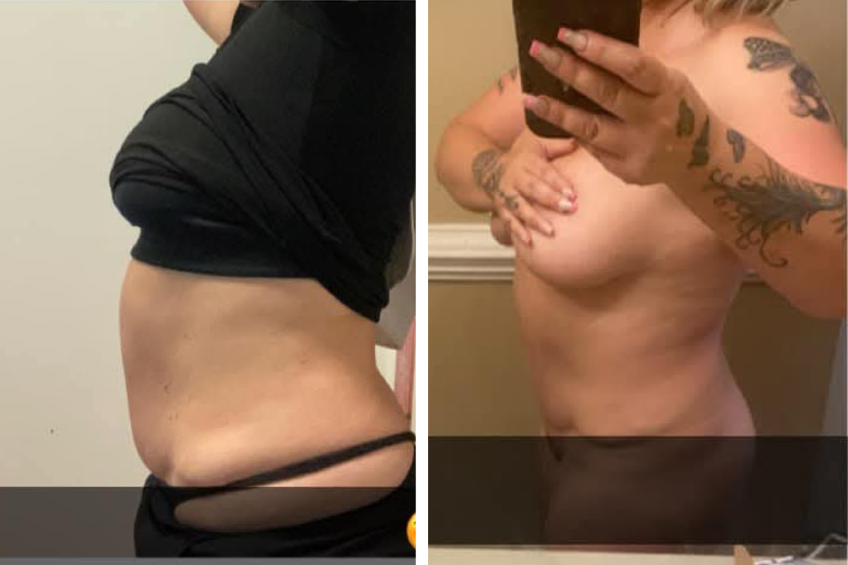 non invasive fat removal  (2).png
