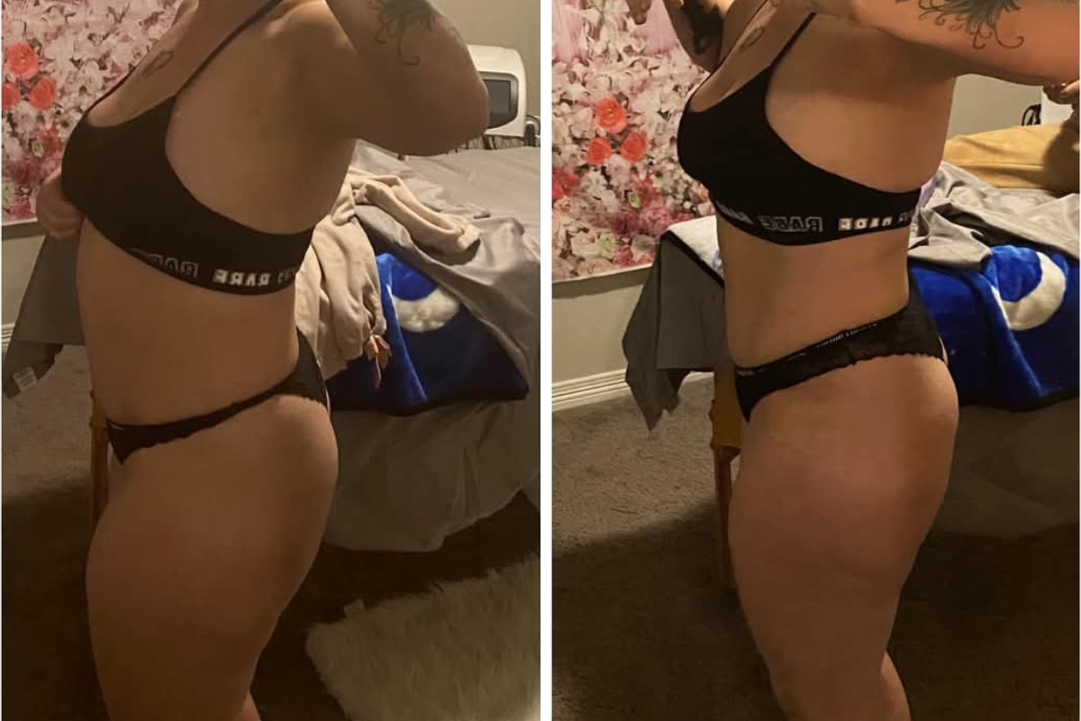 noninvasive fat removal .png