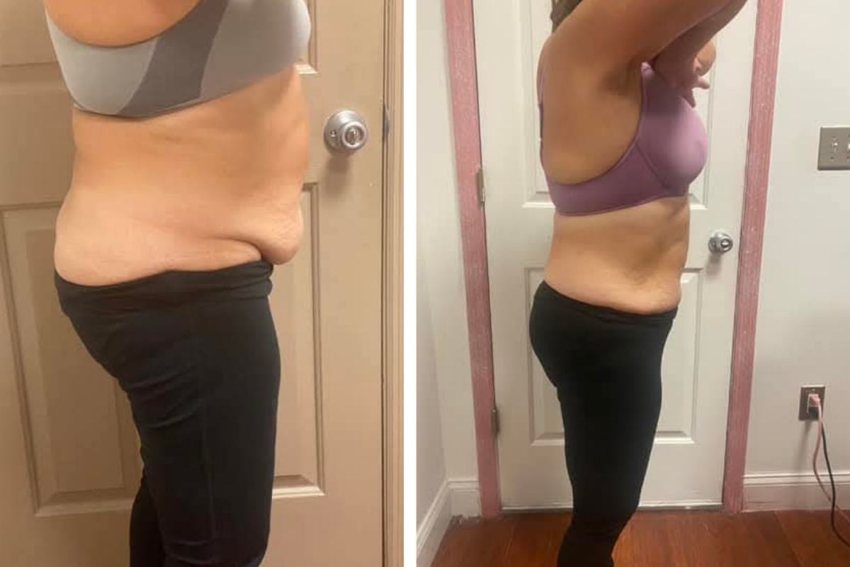 noninvasive fat removal.png