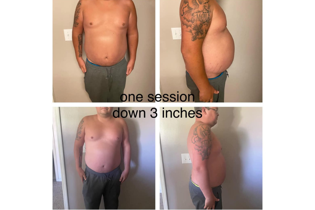 non invasive fat removal  (1).png