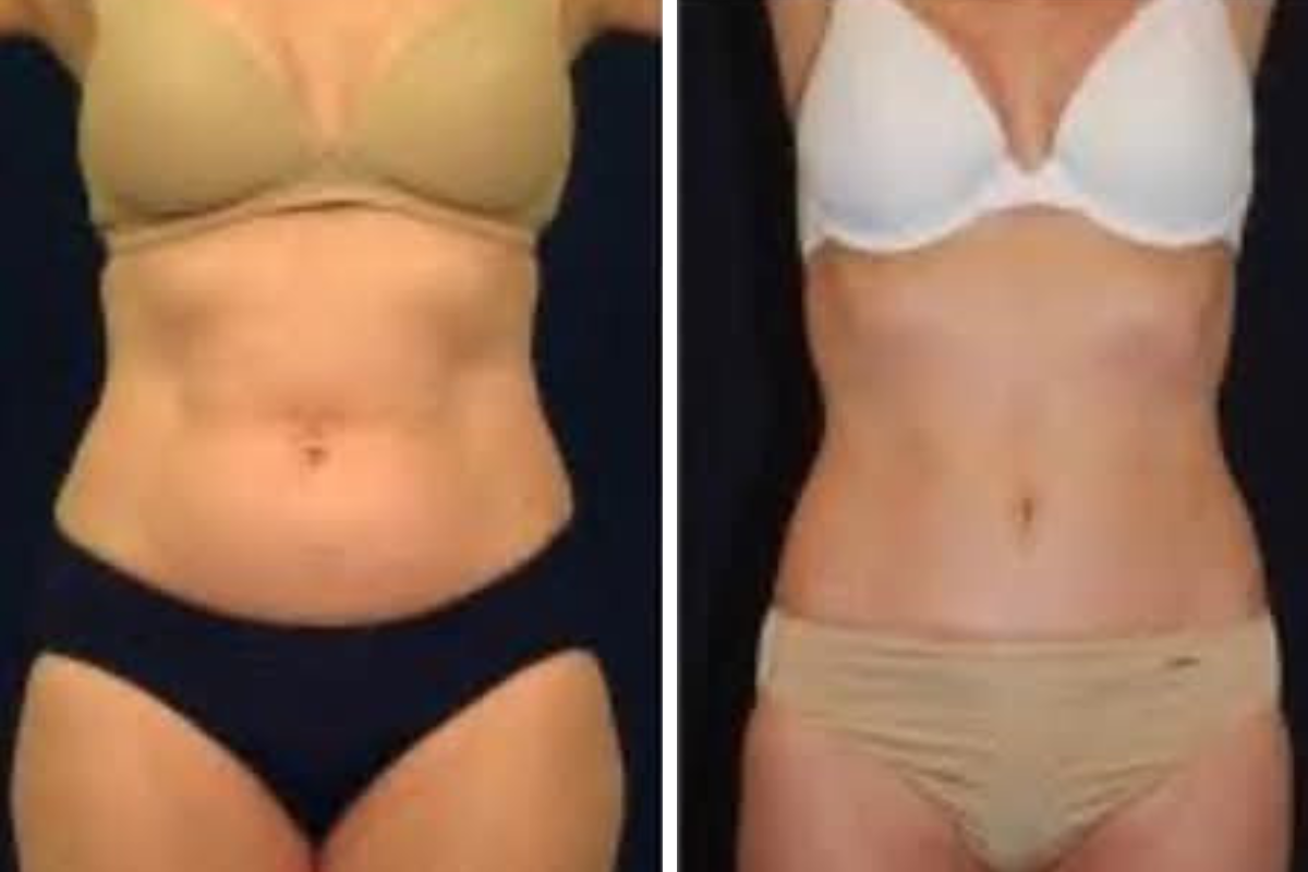 noninvasive fat removal (1).png
