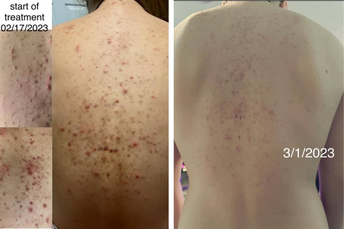 acne treatment .png