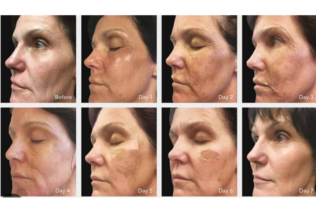 chemical peel.png